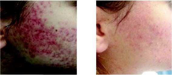prima dopo acne